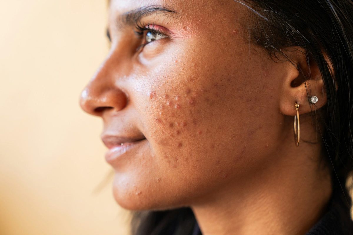girl with acne and dark spots